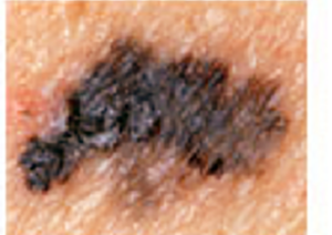 Understanding Basal Cell Carcinoma (BCC): What Australians Need to Know