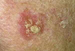 Understanding Actinic Keratosis (AK): What Australians Need to Know