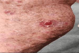 Understanding Squamous Cell Carcinoma (SCC): What Australians Need to Know